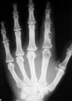 /album/a1/epidermoide-i-png/